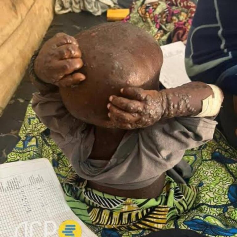 RDC : la cérémonie de déclaration de la fin de l’épidémie de Mpox reportée au 2 avril