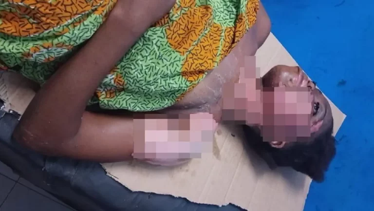 Estelle, victime d’une agression au feu par son mari, demande justice depuis l’hôpital